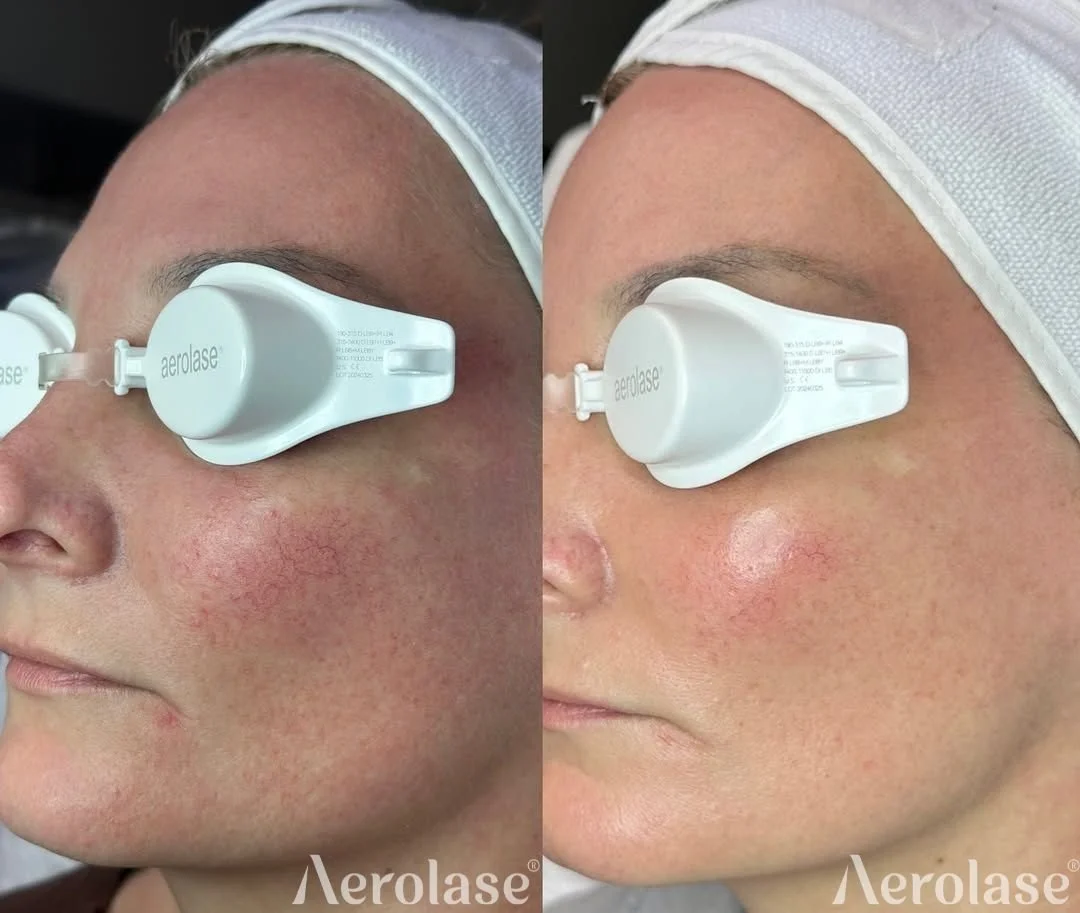 Rosacea Treatment