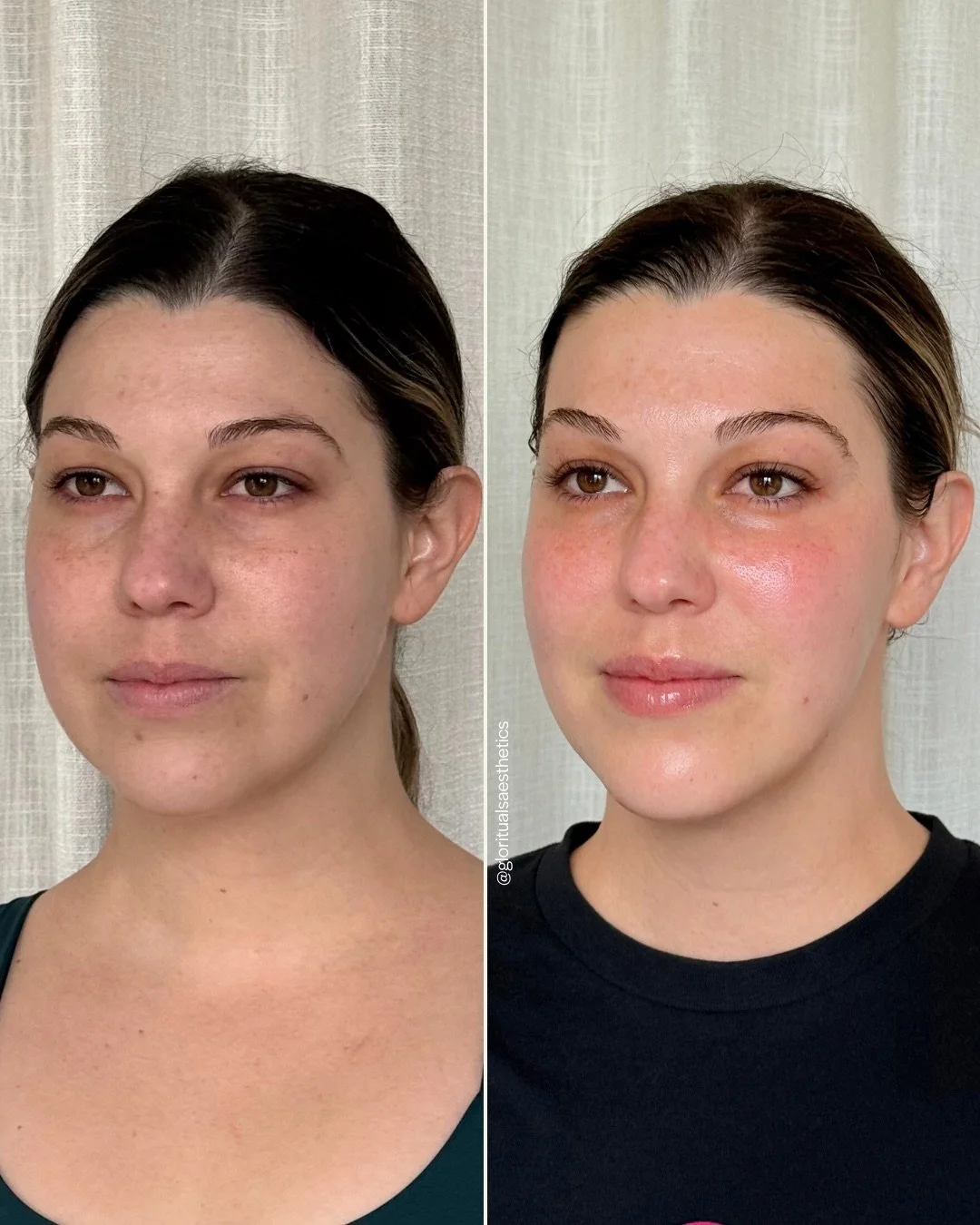 Treatments: Dysport, Facial Balancing Filler, EZ Gel PRF, Hydrafacials
