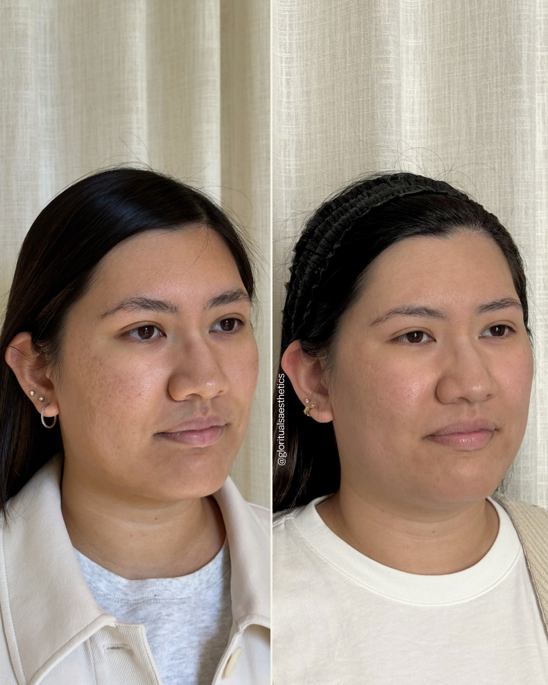 Treatments: Microneedling wtih PDGF, CoolPeel, HydraFacial