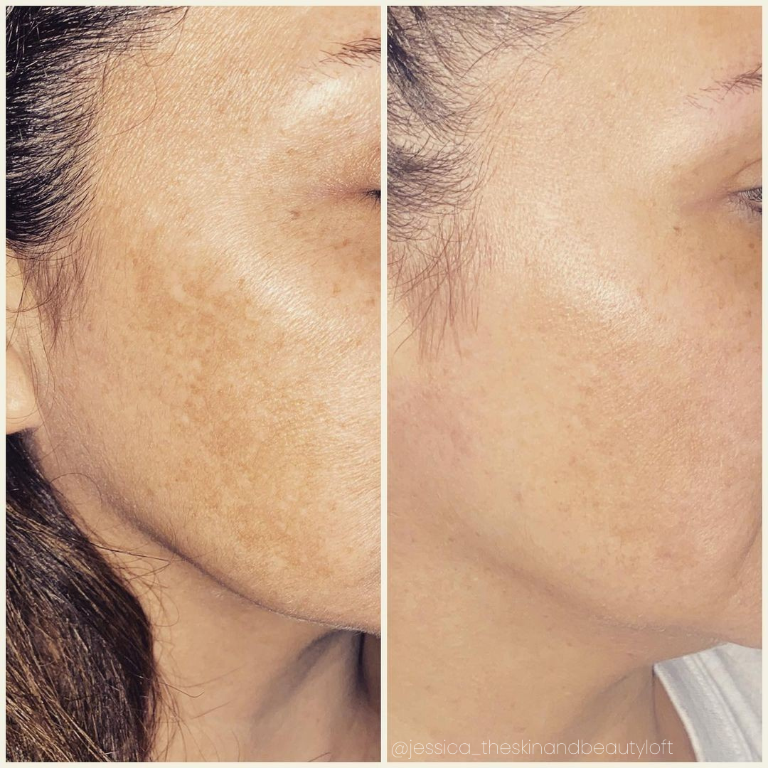 Melasma Treatment