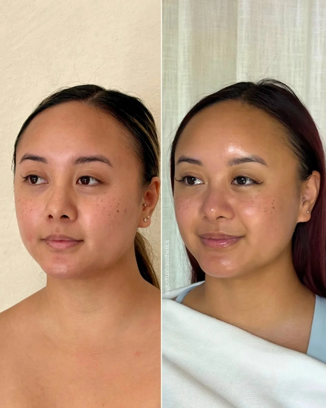 Treatments: Dysport, Facial Balancing Filler, Hydrafacials, Peels
