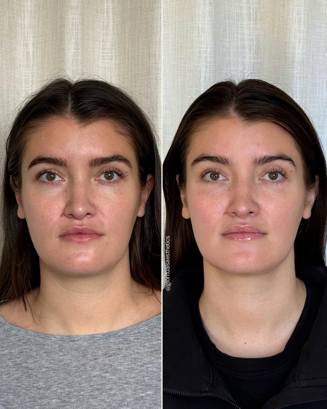 Treatments done: Aerolase Neo Elite Laser + VI Peel