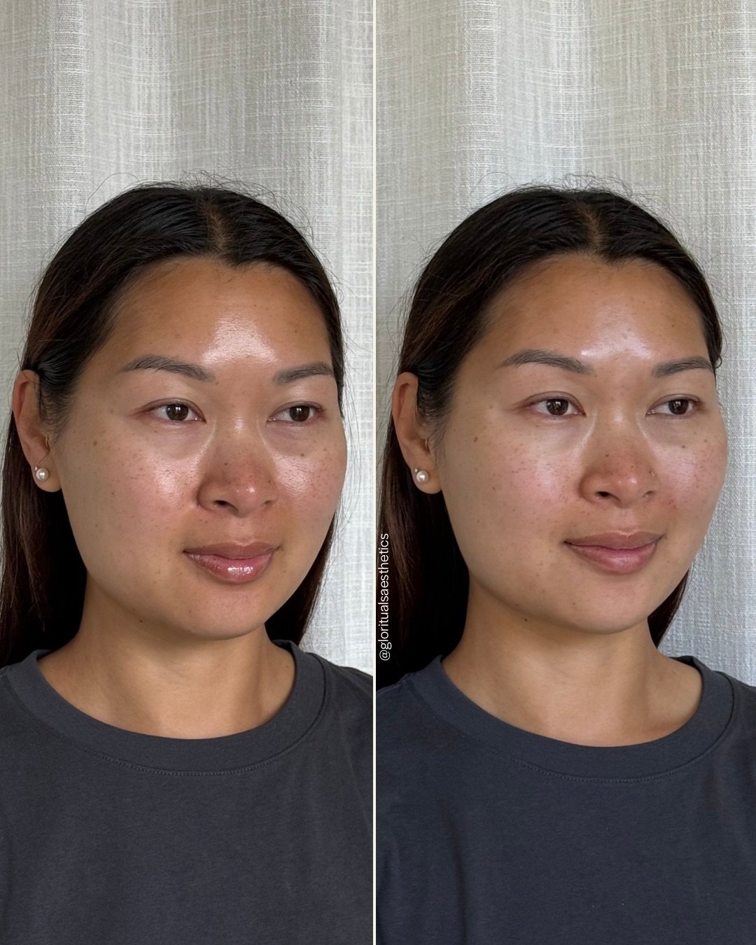 Treatments: Dysport, Filler, Hydrafacials