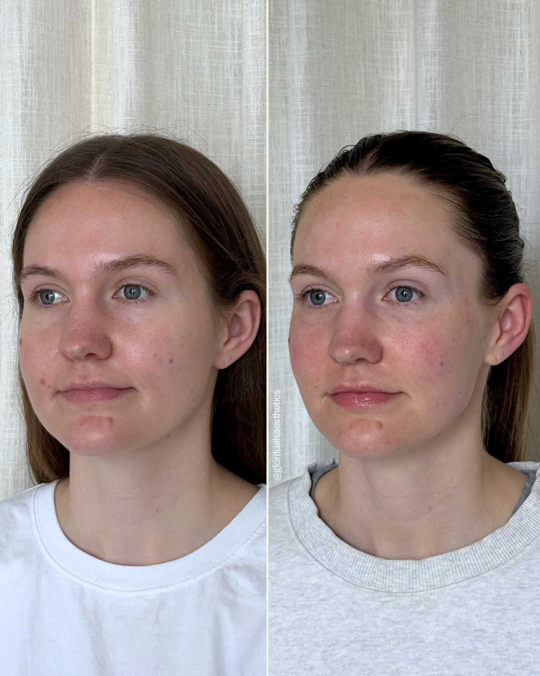 Treatments done: Facial balancing with filler and Dysport