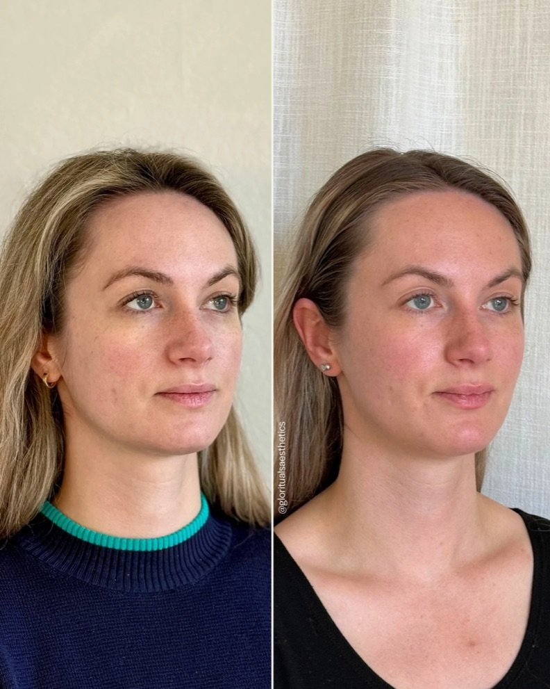 Treatments: Dysport and Filler