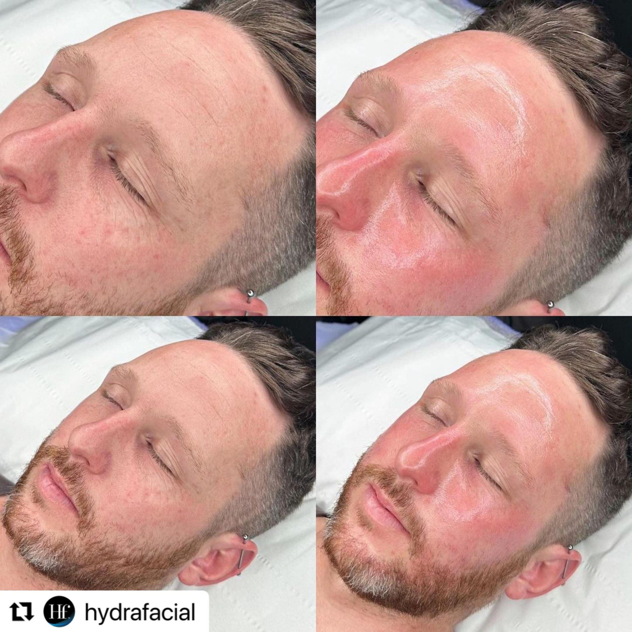We're loving this fantastic result from our friends at @hydrafacial, the proud sponsor of the Esthetician Track at this year's Science of Skincare Summit! 💫

Learn more about Hydrafacial and our other #SSS2024 sponsors, and register today to join us