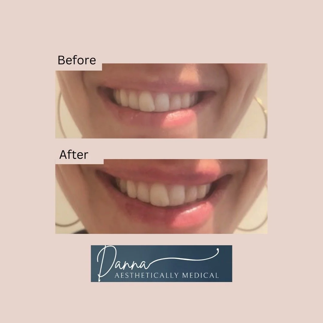 This lovely client already had beautifully shaped lips, but wanted a little definition. 
It's about what you see and how we can work together to show your poutential.

#hackney #dermalfillers #finsburypark #highburyandislington #lips #stokenewingtonc