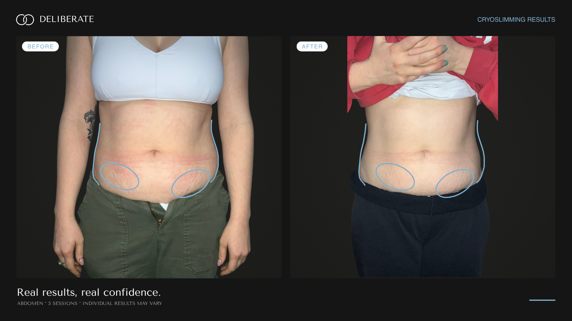 Before and after body contouring, abdomen (stretch marks), 5 sessions, Deliberate Wellness Studio in Vineyard, UT