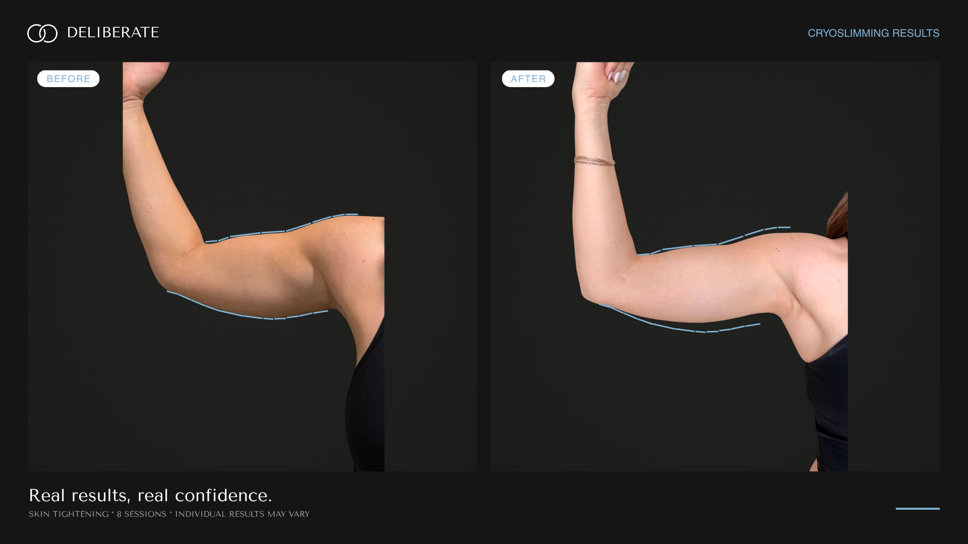 Before and after body contouring, arms (skin tightening), 8 sessions, Deliberate Wellness Studio in Vineyard, UT