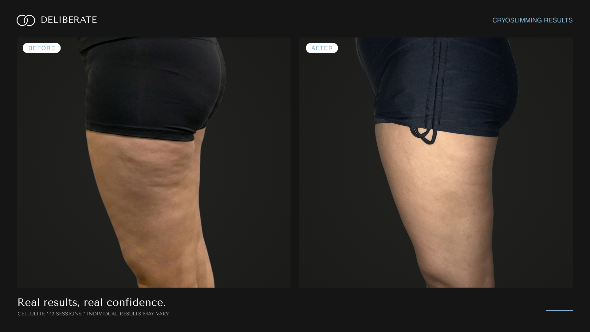Before and after body contouring, cellulite, 12 sessions, Deliberate Wellness Studio in Vineyard, UT