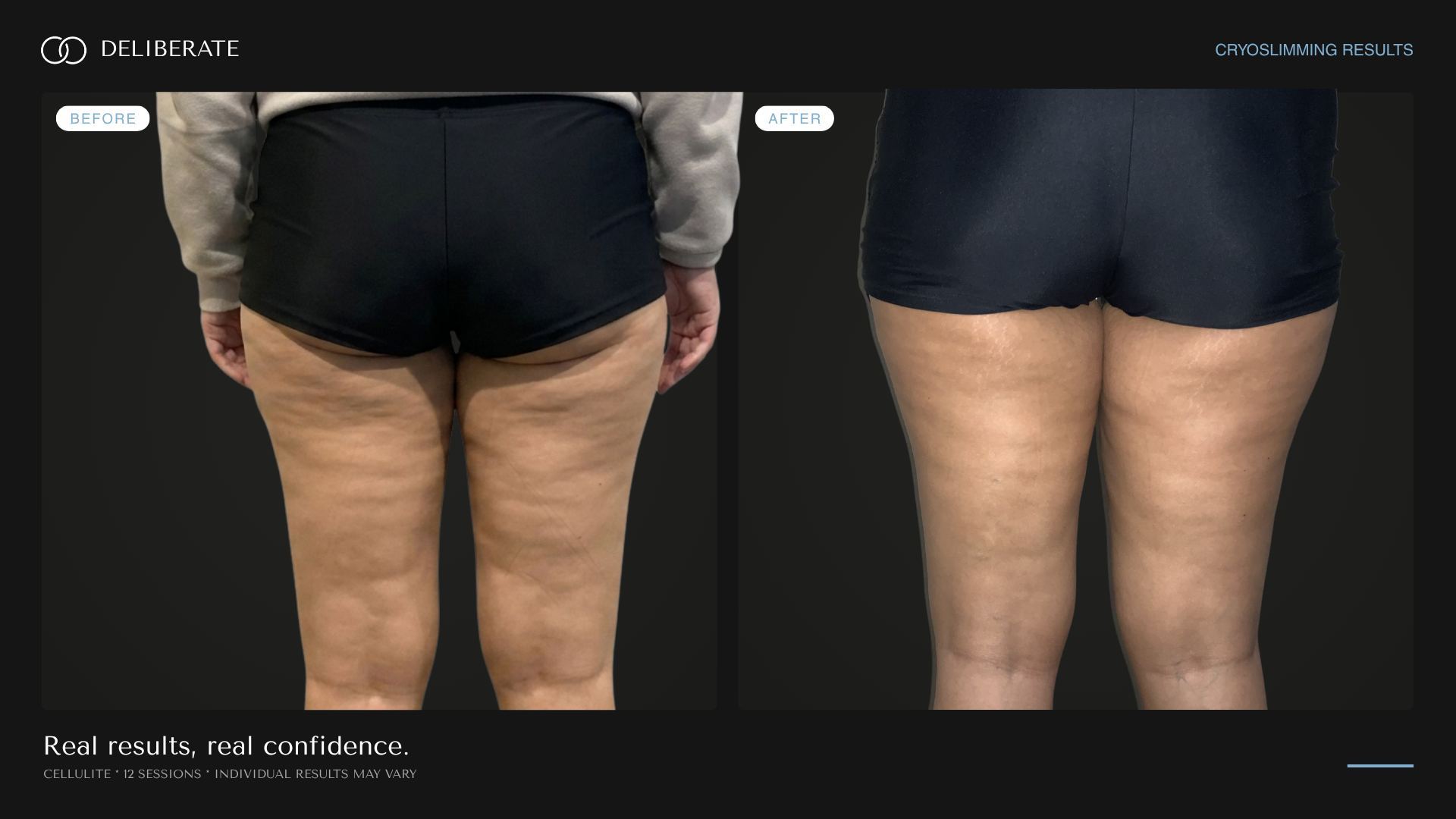 Before and after body contouring, cellulite, 12 sessions, Deliberate Wellness Studio in Vineyard, UT