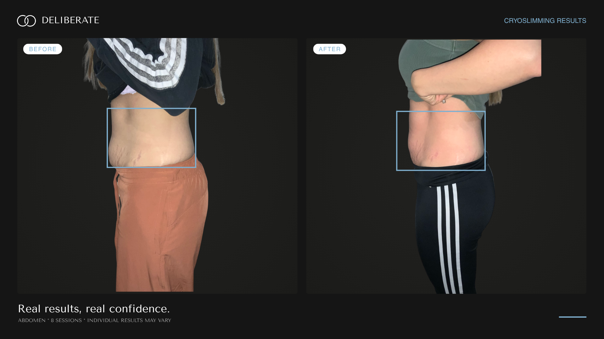 Before and after body contouring, abdomen, 8 sessions, Deliberate Wellness Studio in Vineyard, UT