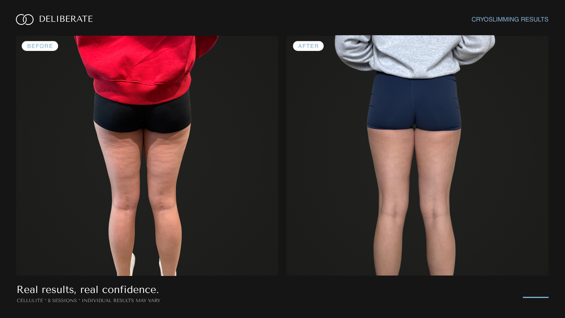 Before and after body contouring, cellulite, 8 sessions, Deliberate Wellness Studio in Vineyard, UT