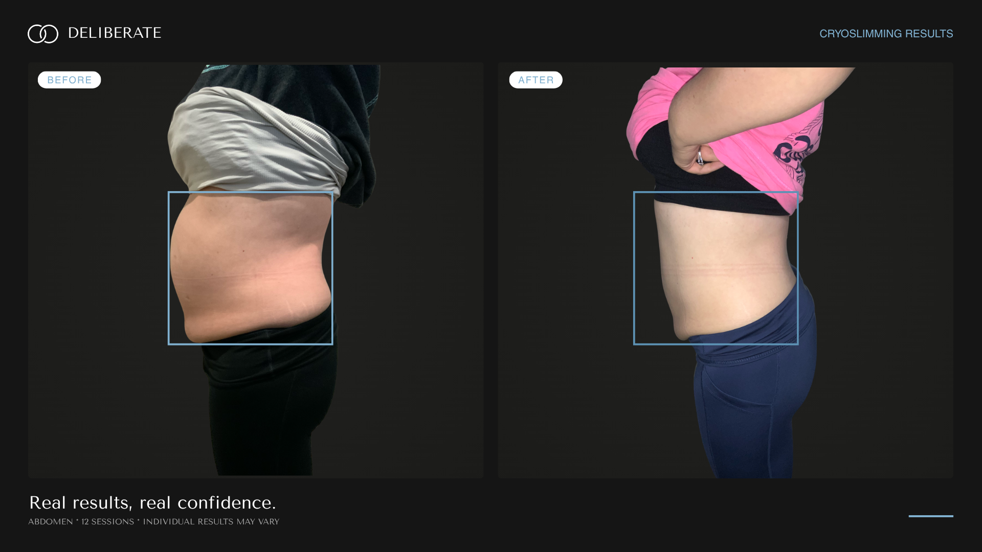 Before and after body contouring, abdomen, 12 sessions, Deliberate Wellness Studio in Vineyard, UT