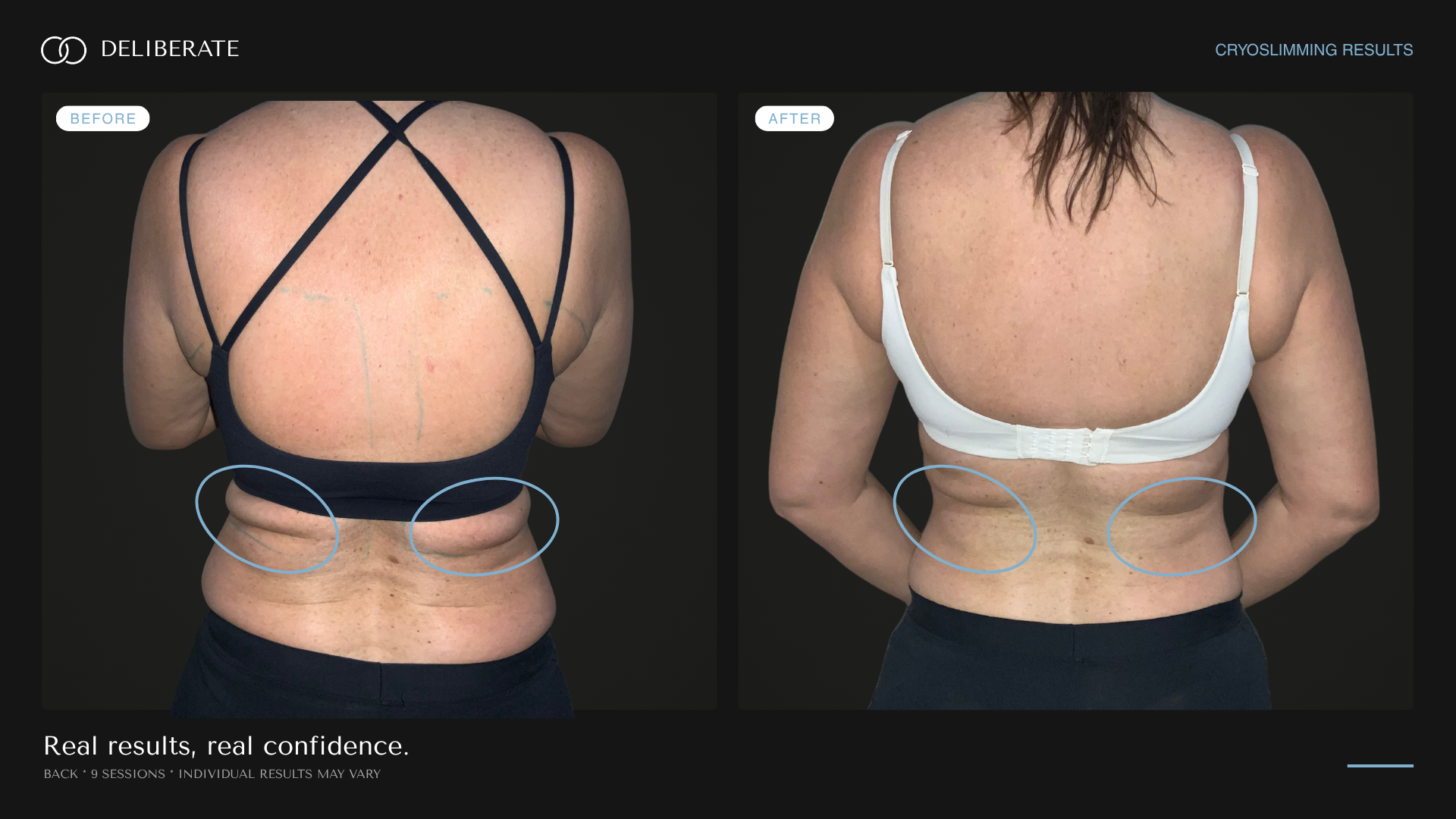 Before and after body contouring, Back, 9 sessions, Deliberate Wellness Studio in Vineyard, UT
