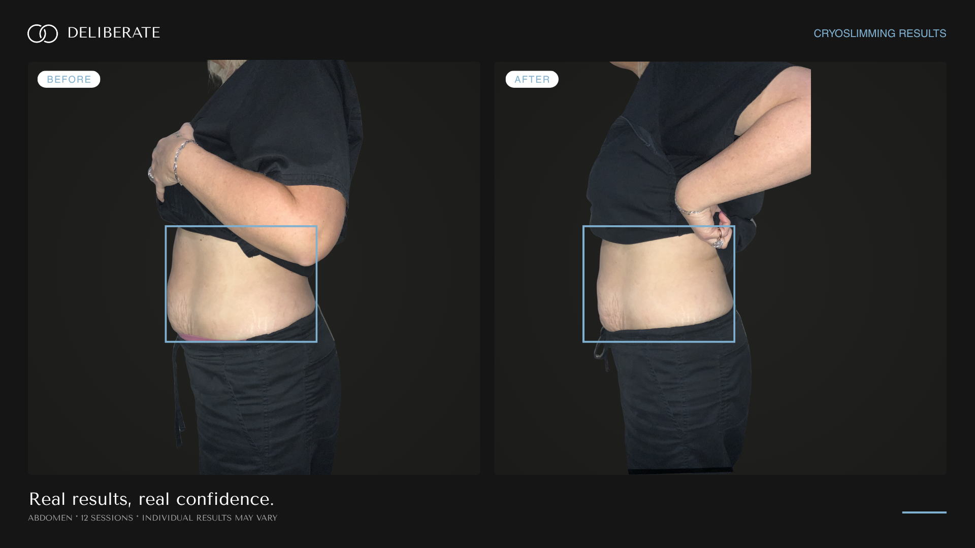 Before and after body contouring, abdomen, 12 sessions, Deliberate Wellness Studio in Vineyard, UT
