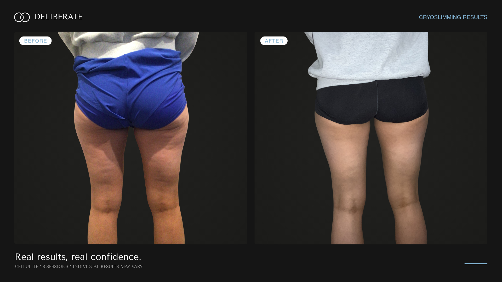 Before and after body contouring, abdomen, 8 sessions, Deliberate Wellness Studio in Vineyard, UT