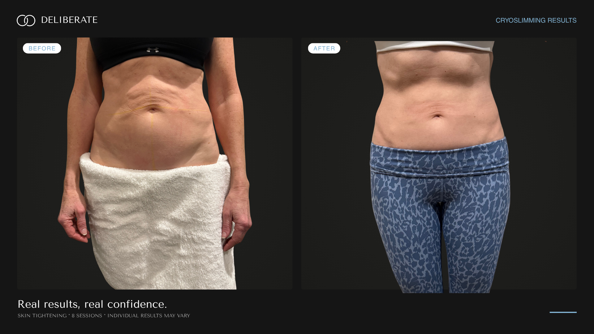 Before and after body contouring, abdomen (skin tightening), 8 sessions, Deliberate Wellness Studio in Vineyard, UT