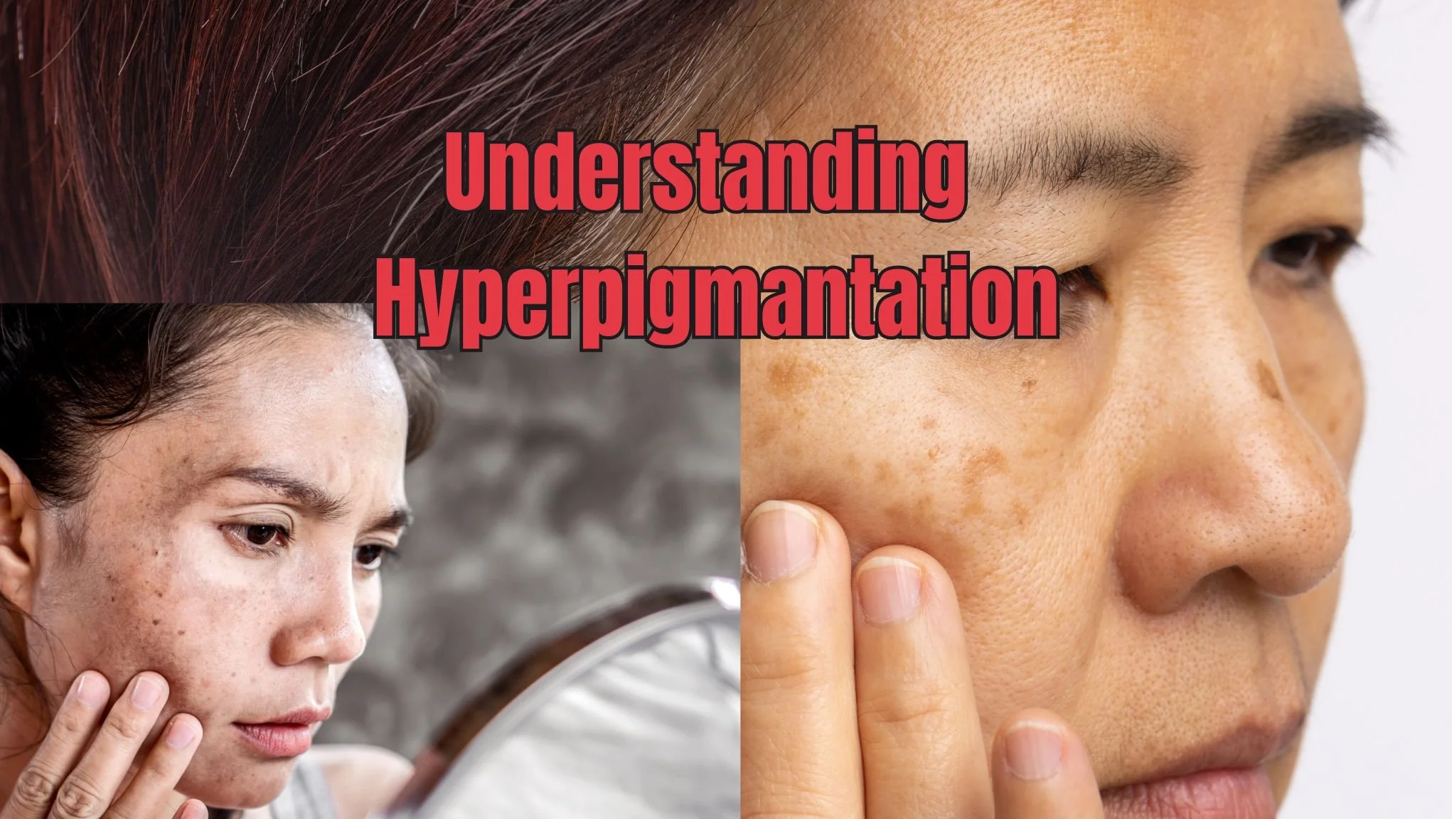 Hyperpigmentation a real challenge specially for women, the image shows a woman facing the pigmentation of her face, thinking whats the best treatment or facial for pigmentation in miami.