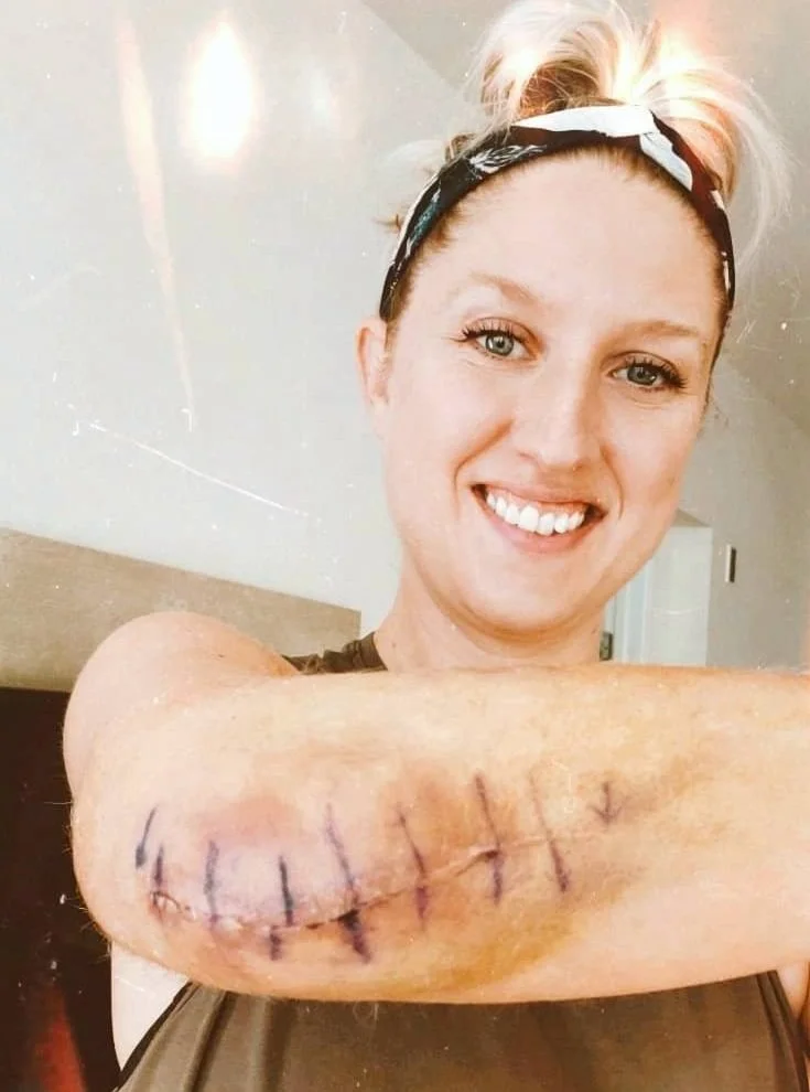 A woman smiling, showing her arm with fresh stitches and bruising after a recent surgery or injury, wearing a black headband with a white pattern.
