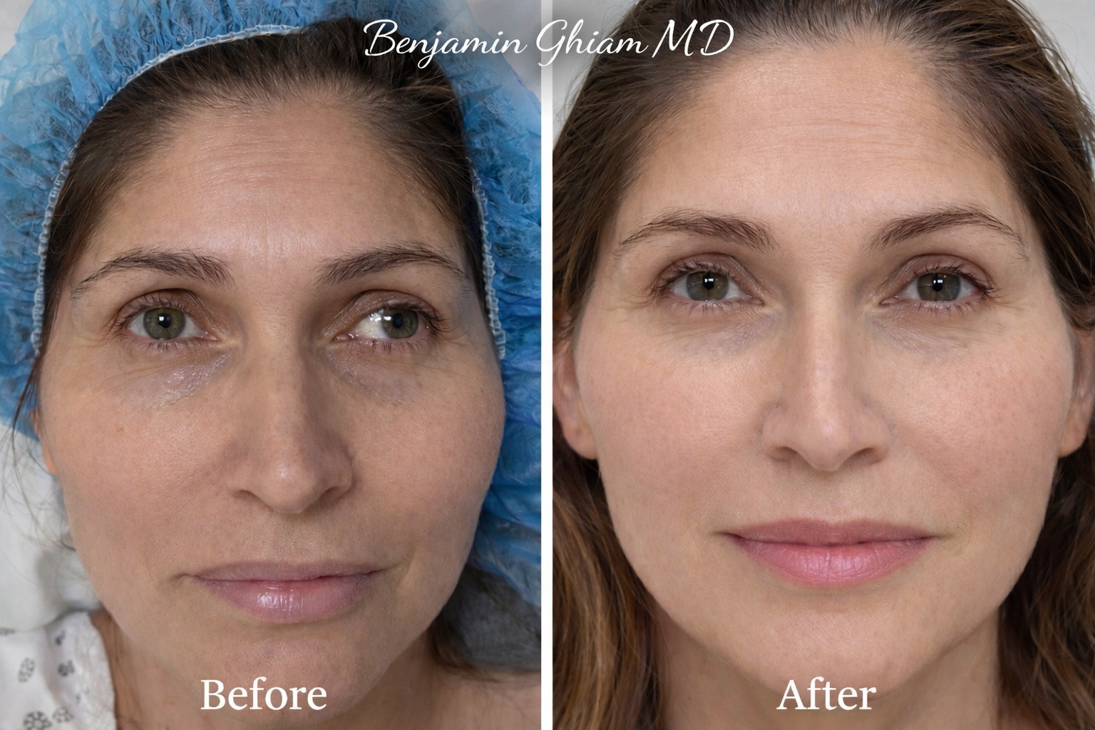 Strabismus surgery is a safe and effective option to correct double vision and ocular misalignment