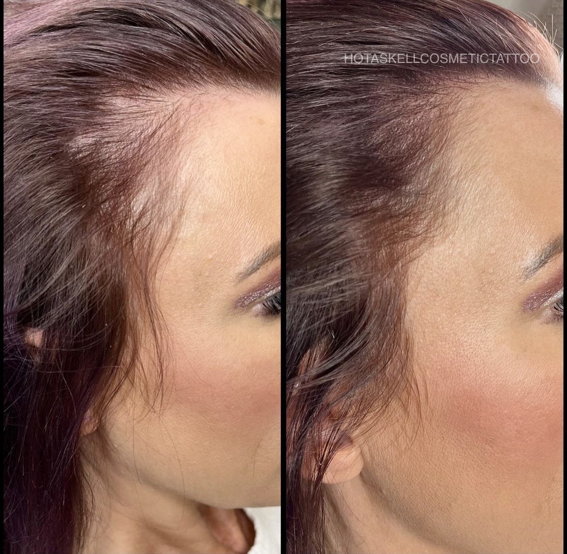 scalp micropigmentation example on roots