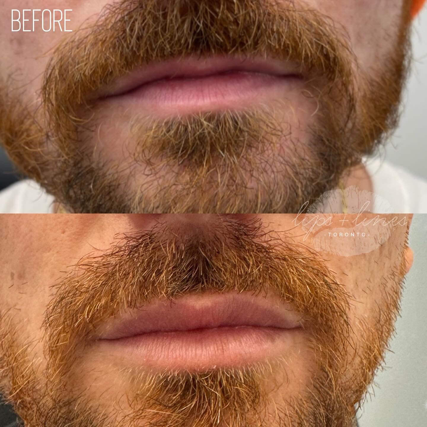 So obsessed with this cuties lip transformation 😍 we&rsquo;ve been slowly building his M shaped lips to achieve this natural full look #lips #lipsbymarg #torontobotox #botoxtoronto #torontomedspa