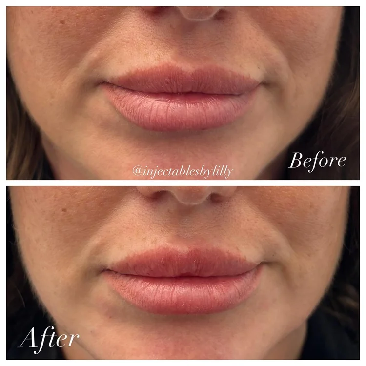 Lips before and after lip filler