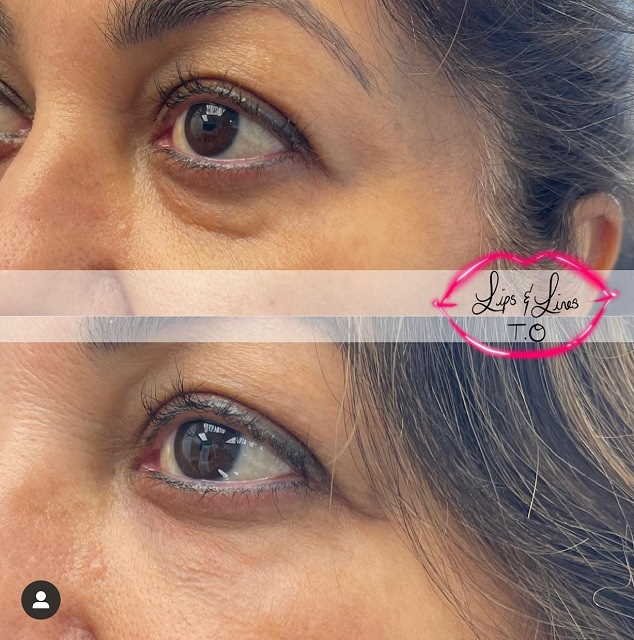 Eye area before and after treatment