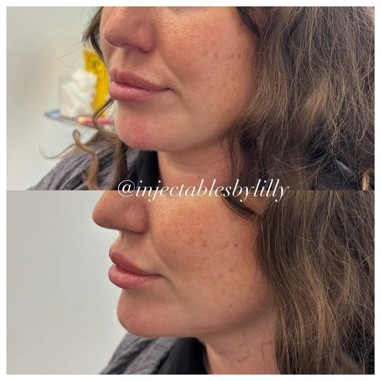 Lips before and after lip filler