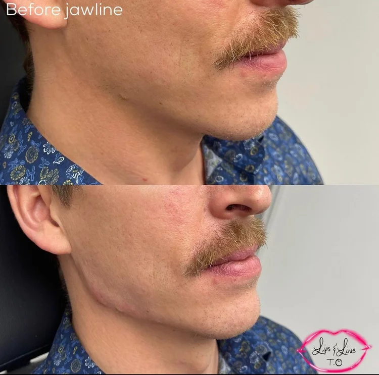 Jawline before and after treatment