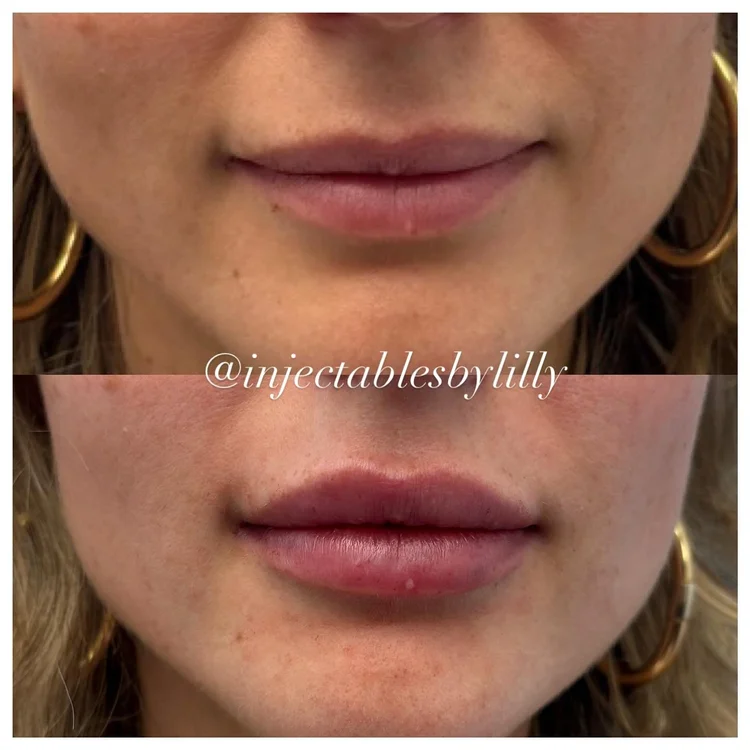 Lips before and after lip filler