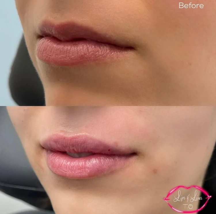 Lips before and after lip filler