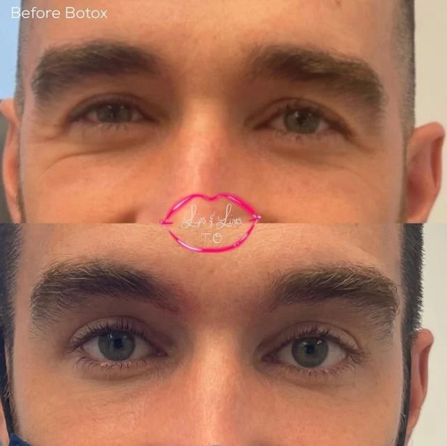 Eyes and brow before and after Botox