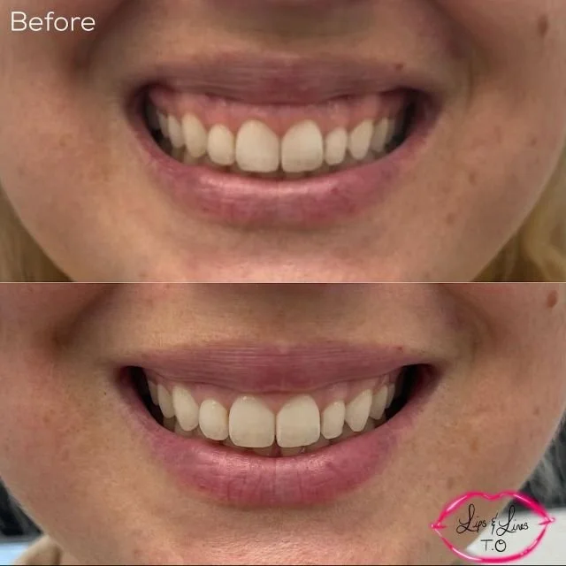 Smile before and after treatment