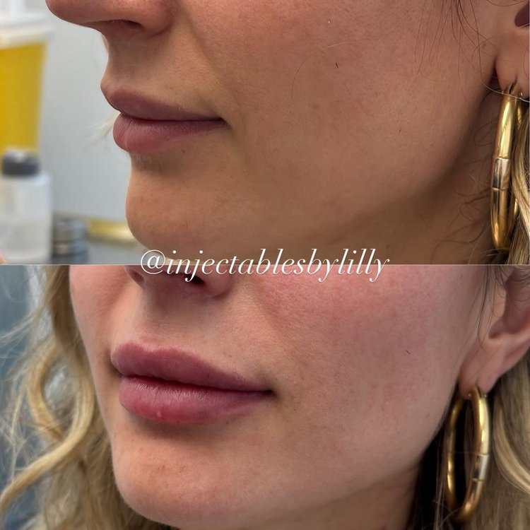 Lips before and after lip filler
