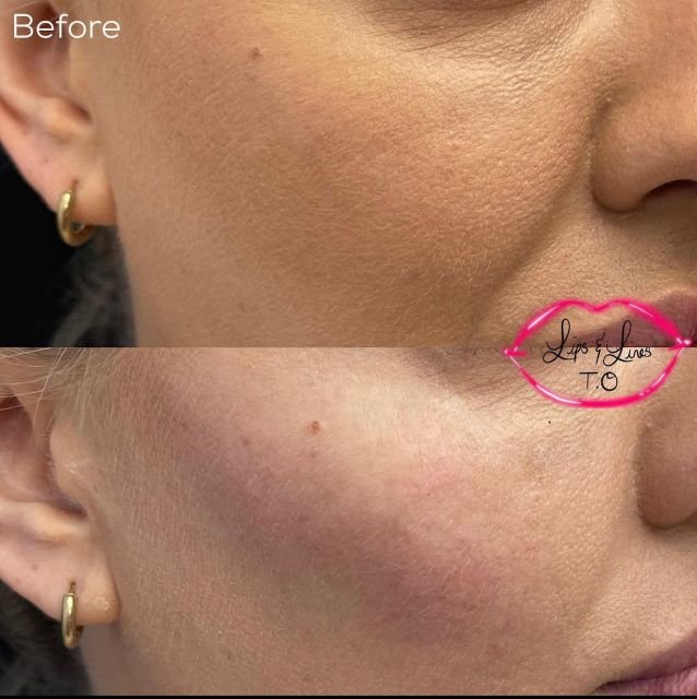 Cheek before and after treatment