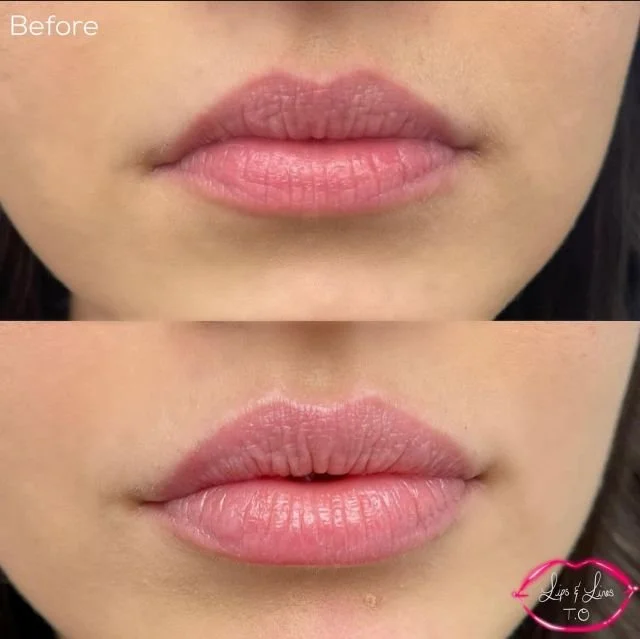 Lips before and after lip filler