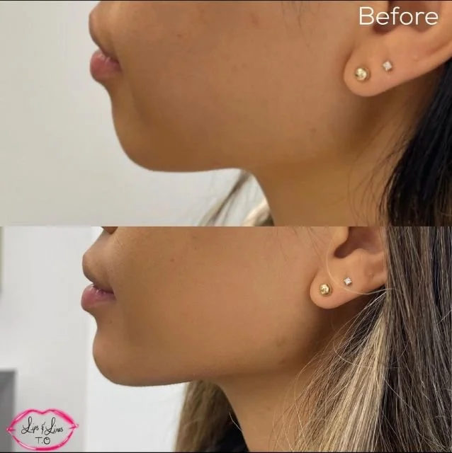 Chin and jawline before and after treatment