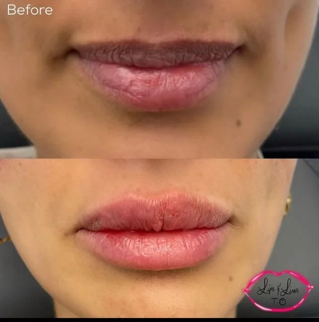 Lips before and after lip filler