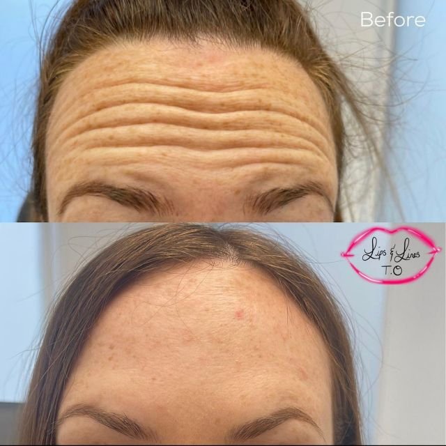 Forehead before and after Botox