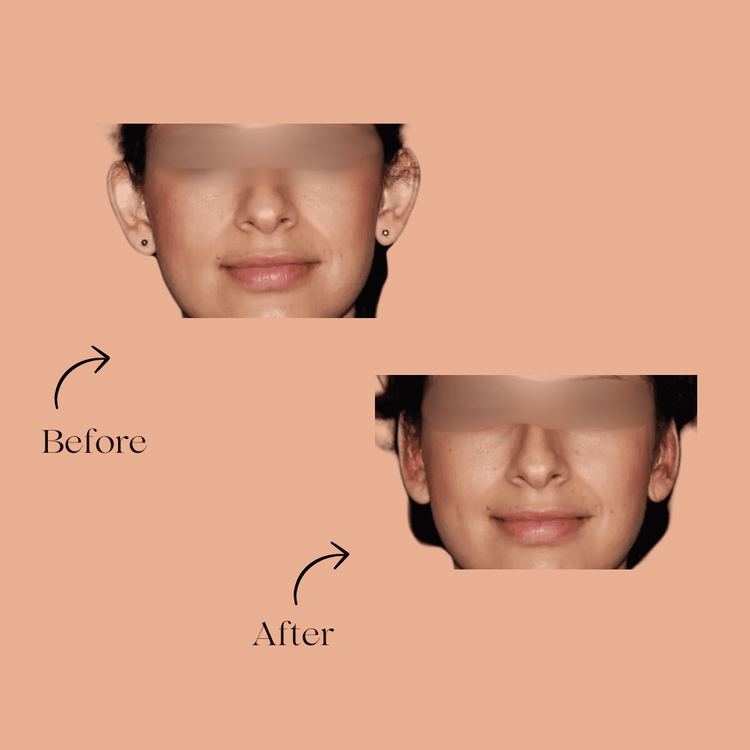 Otoplasty before and after result at Adonis Plastic Surgery in Torrance