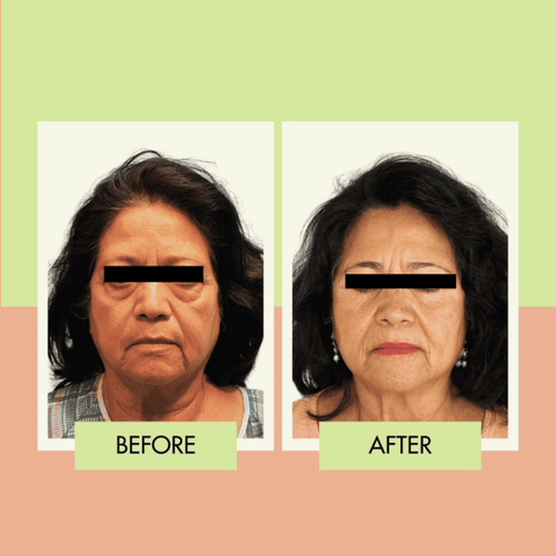 Under-eye bag surgery before and after for a South Bay patient