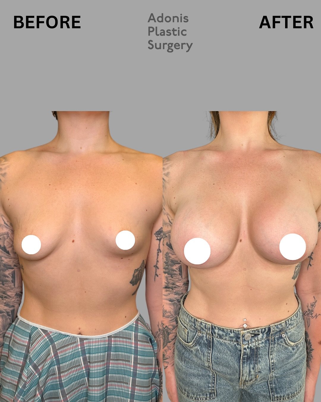 Swipe to see this patients stunning breast augmentation results! ⏭️

Breast augmentation is a surgical procedure that enhances the size, shape, and symmetry of the breasts using silicone or saline implants&mdash;customized to your goals and body type