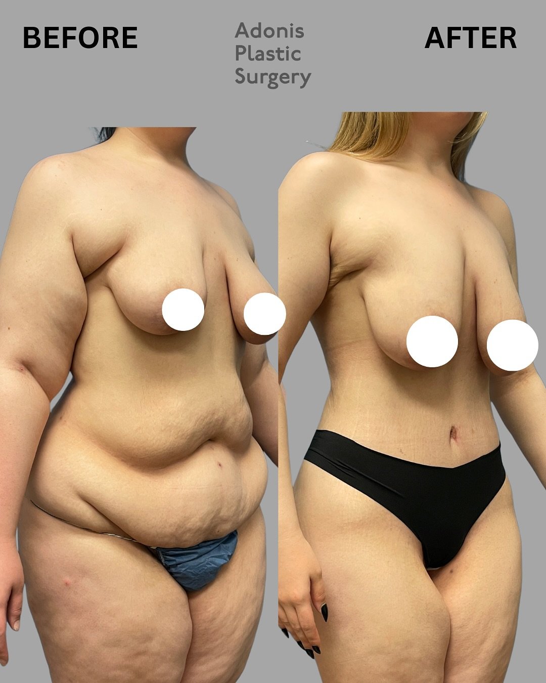 Considering a body transformation? 🤔 

A tummy tuck (abdominoplasty) and arm lift (brachioplasty) are two highly effective procedures that target areas resistant to diet and exercise. 

A tummy tuck removes excess skin and tightens abdominal muscles