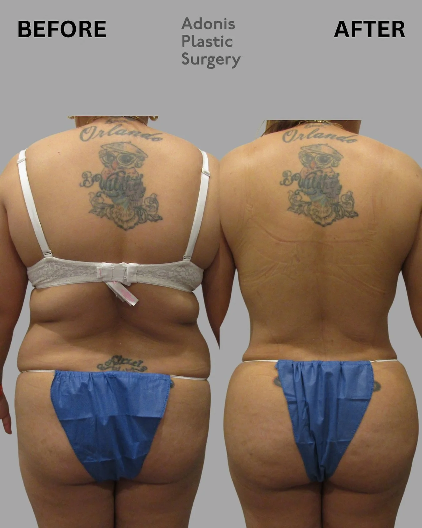 This beautiful before and after is the result of liposuction combined with a Brazilian Butt Lift (BBL)&mdash;a powerful body contouring procedure that sculpts the midsection while enhancing the buttocks for a fuller, more feminine silhouette.⁠

Durin