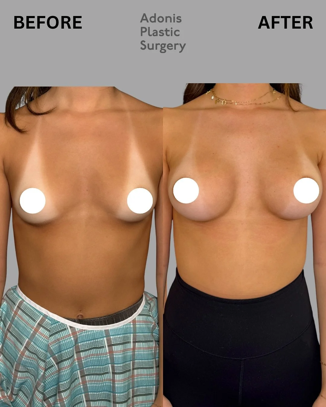 More and more women are choosing smaller, natural-looking breast implants&mdash;often called &ldquo;ballerina breasts.&rdquo; These implants offer a refined, athletic, and elegant silhouette that enhances the body without overpowering it.⁣
⁣
👙 In th