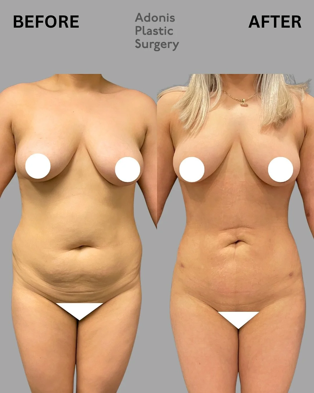 This stunning transformation was achieved with a combination of Lipo 360 and a Brazilian Butt Lift&mdash;designed to enhance natural curves while maintaining a soft, undetectable look.⁣
⁣
💉 What is Lipo 360 + BBL?
Lipo 360 targets the entire midsect