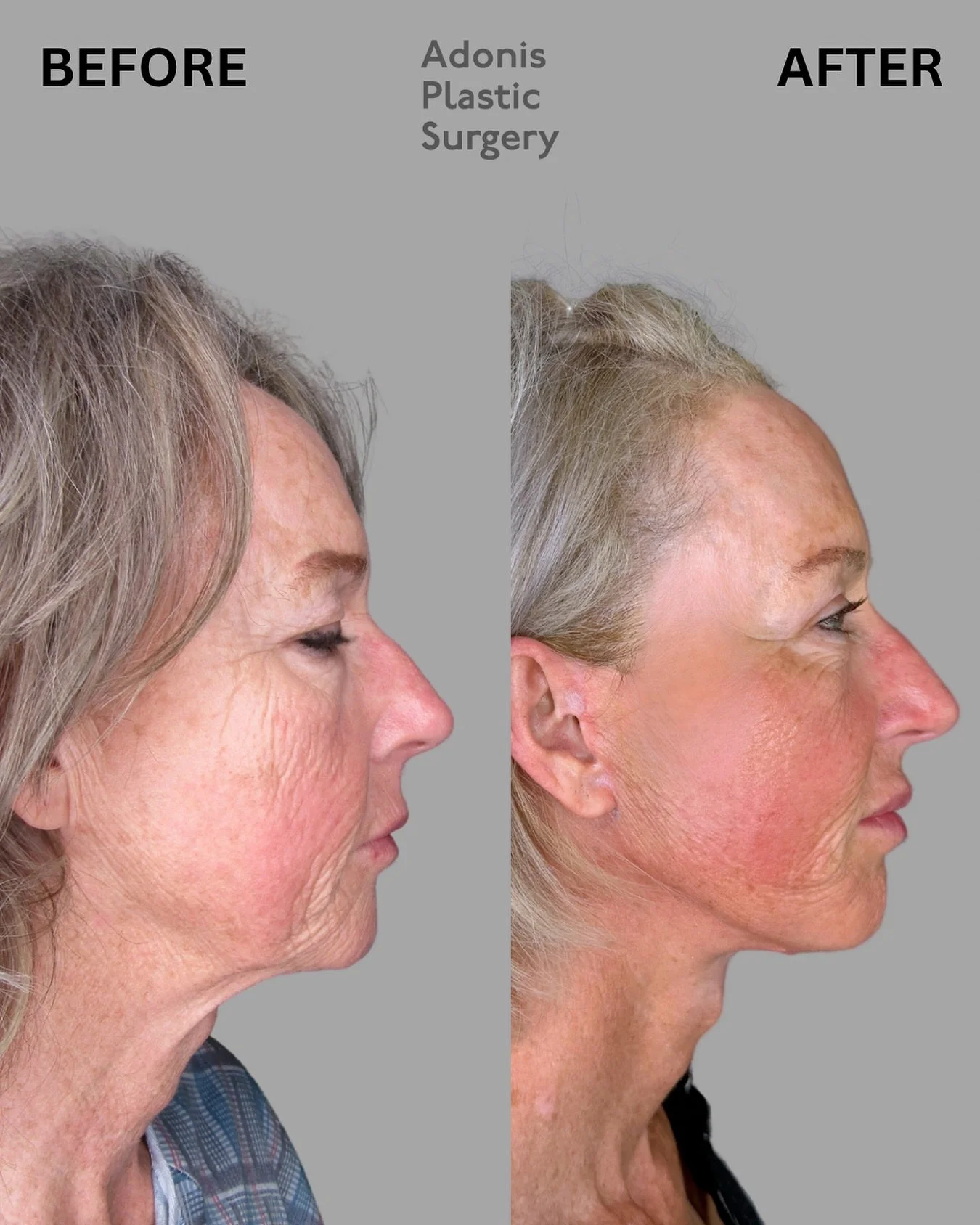 Our beautiful patient came to us seeking a refreshed, younger look without changing her natural appearance. The goal? A subtle, undetectable lift that left her looking like herself&mdash;just well-rested, smoother, and more confident.

🧬 Using advan