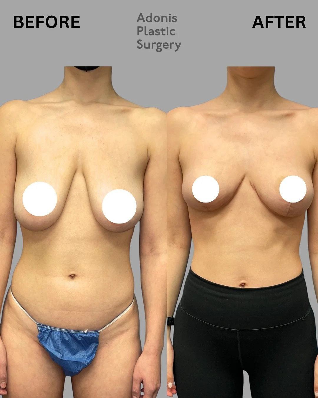 A breast lift can make all the difference &mdash; and this beautiful transformation is proof. ✨👙⁣
⁣
Many women choose a breast lift (mastopexy) to address sagging, loss of volume, or downward-facing nipples &mdash; often caused by aging, pregnancy, 